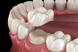 Digital illustration of a dental crown in Rockville 