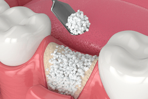bone graft included in cost of dental implants in Rockville