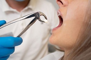 Dentist removing woman’s tooth with forceps 