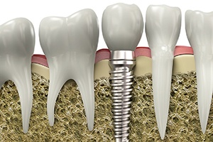 Model of a dental implant in jawbone.