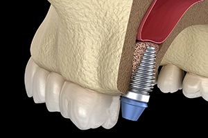 Dental implant in jaw after bone grafting.