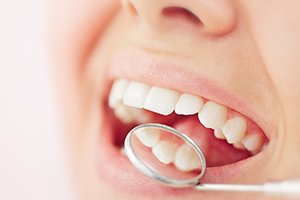 Closeup of someone’s teeth reflected in dental mirror