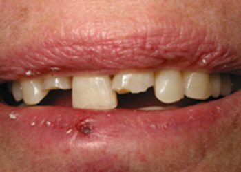 Closeup of broken teeth