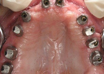 Closeup of smile with dental implants in place