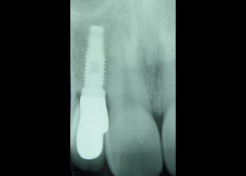X-ray of implant supported replacement tooth
