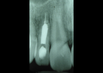 X-ray of severely damaged tooth