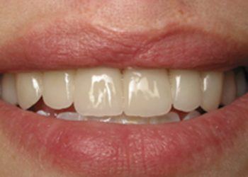 Closeup of flawless healthy smile