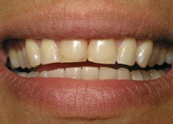 Closeup of worn teeth shortened teeth