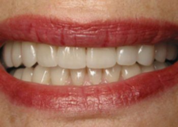 Closeup of flawless healthy smile