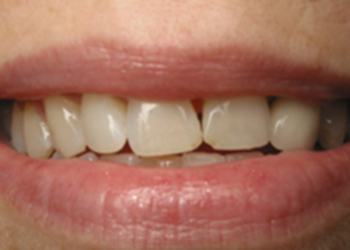 Closeup of teeth wtih gaps and overlapping teeth