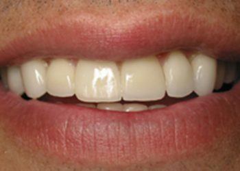 Closeup of repaired teeth