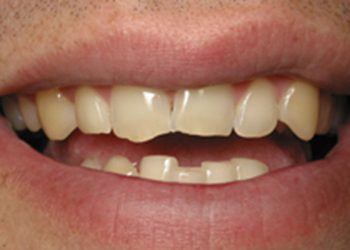 Closeup of chipped and cracked teeth