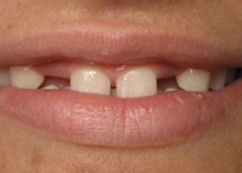 Closeup of smile with missing teeth