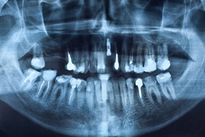 X-ray of smile with implant supported replacement teeth