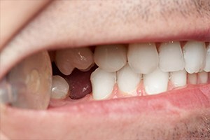 Closeup of smile missing bottom tooth