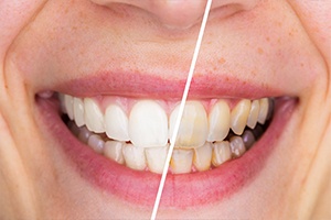 Smile half before and half after teeth whitening