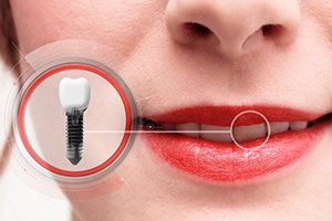 close-up of a woman with a dental implant smiling