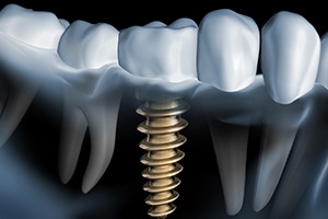 3D illustration of X-ray of a patient with a dental implant