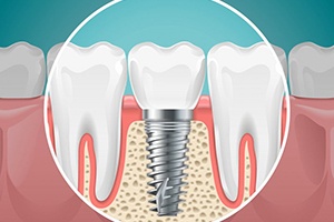 illustration of a dental implant in the jawbone