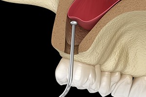 model of a sinus lift