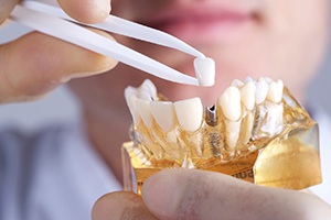 dentist placing a crown on top of a dental implant model