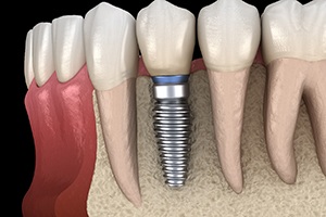 single dental implant in the lower jaw