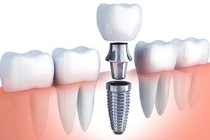 3D illustration of a dental crown being placed on top of a dental implant