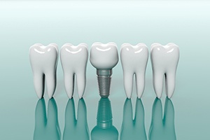 illustration of dental implant with crown between several natural teeth