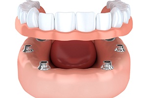 Computer generated model of dentures and dental implants