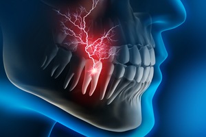 Image of a lightning bolt in the root of a tooth