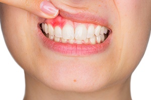 Closeup of red inflamed gums