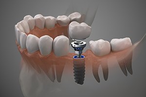 Diagram showing a single tooth dental implant in Rockville 