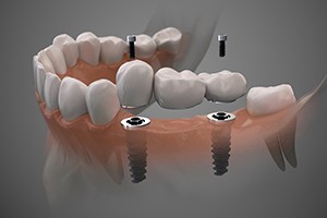 Diagram showing an implant bridge replacing multiple missing teeth in Rockville
