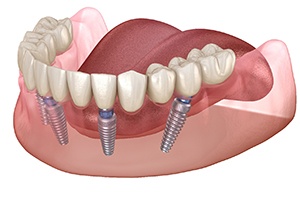 Diagram showing all-on-4 implant dentures in Rockville 