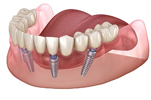 Diagram showing all-on-4 implant dentures in Rockville