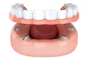 A diagram of an implant-retained denture.