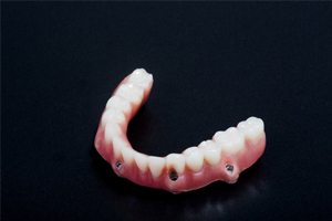An implant-retained denture.