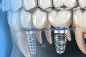 computer model of dental implant replacement teeth