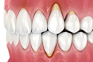 Illustration of receding gums