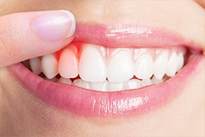 Closeup of smile with damaged gums