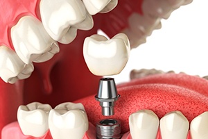 Animation of implant supported dental crown