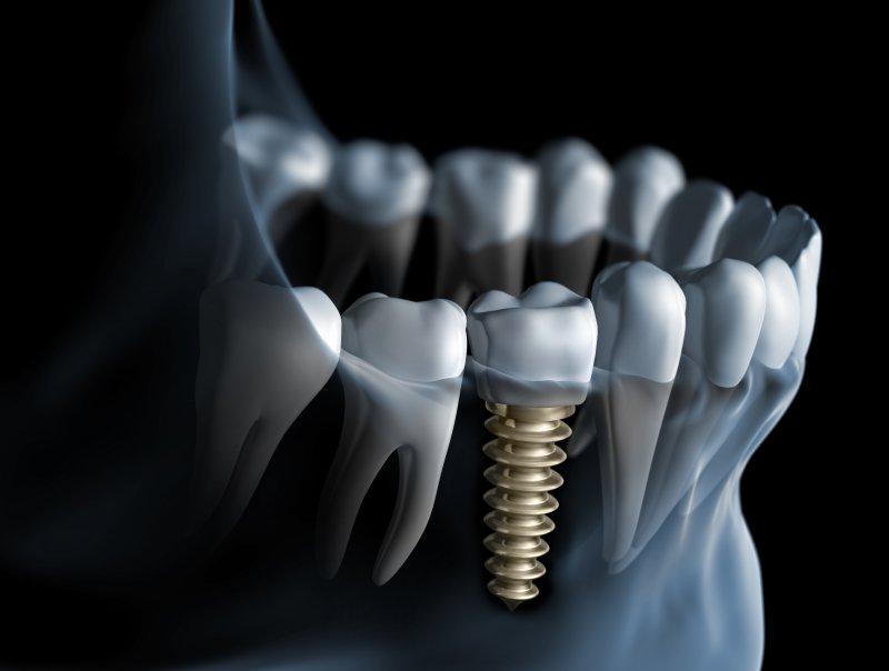 Dental Implant in Jaw