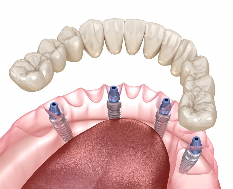 All-on-4 dental implants