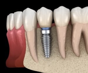 Model of a dental implant replacing a lower tooth