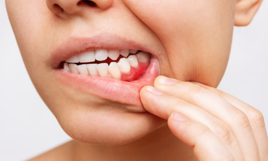 Close up of woman with inflamed gums