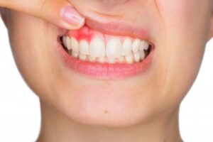 Person smiling and pulling up upper lip to show red gums.